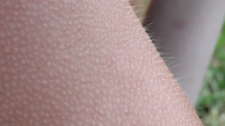 Close-up of goosebumps raised across the skin of a human arm